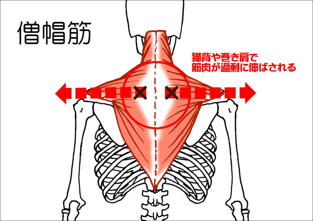 僧帽筋の緊張