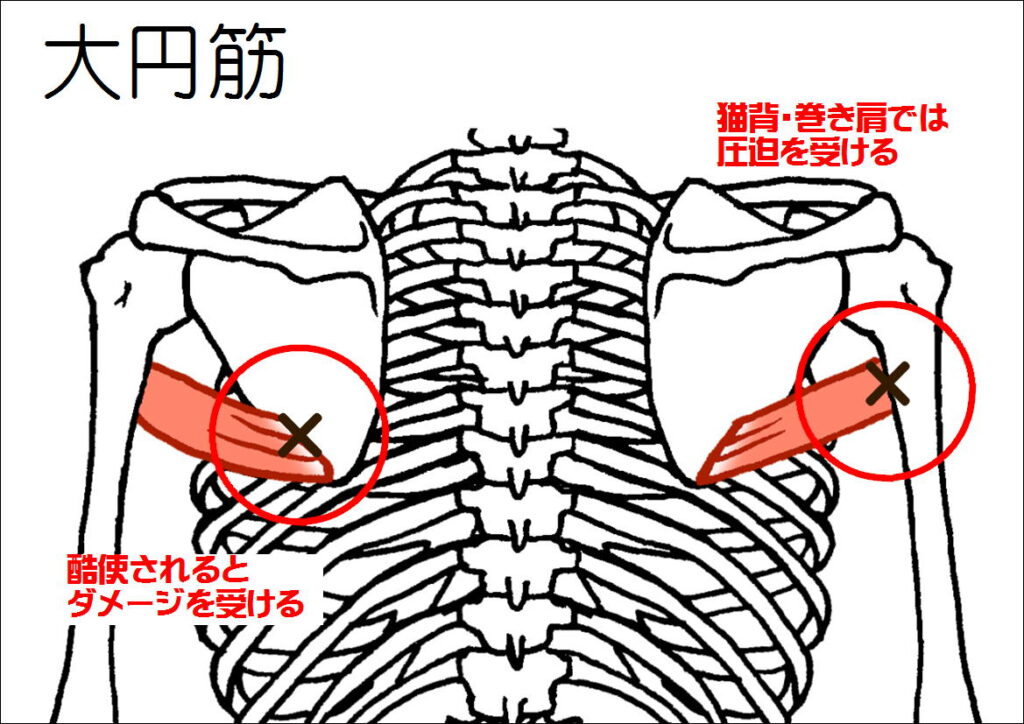 大円筋のダメージ