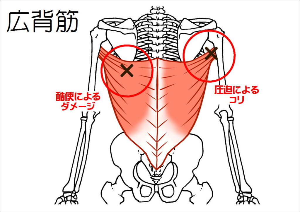 広背筋のダメージ