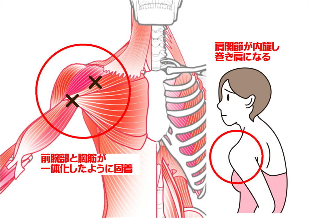 前腕と胸筋の固着