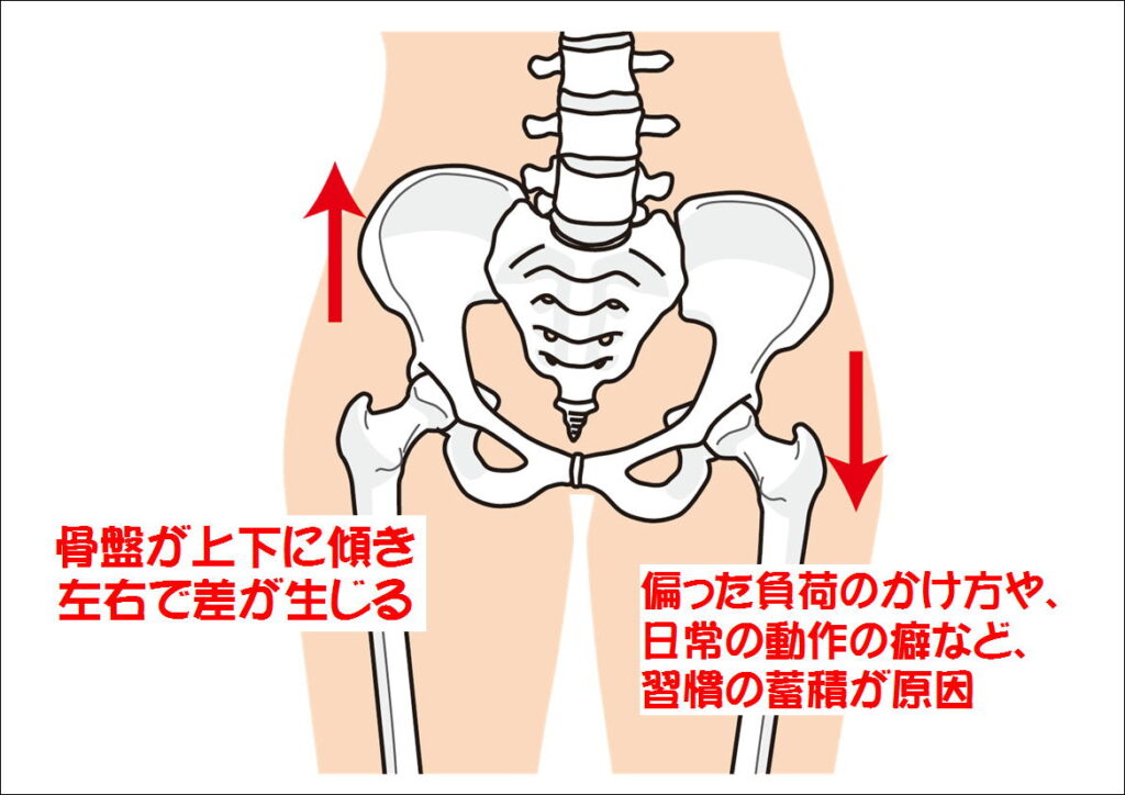 骨盤の左右差