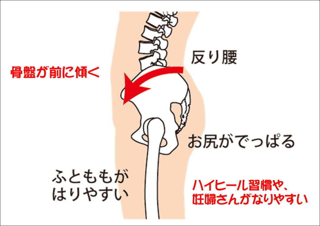 骨盤の前傾